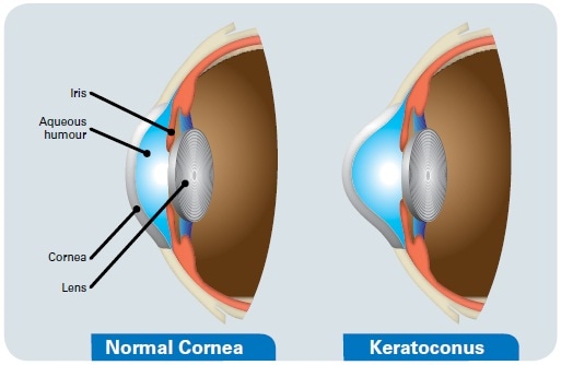 Keratoconus effects on the eye.