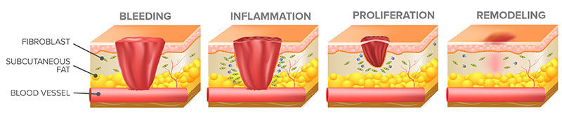The wound healing process involves overlapping stages of bleeding, inflammation, proliferation, and remodeling (epithelialization).