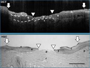 Visualization of tissues in ex vivo human wounds with (a) histologic evaluation and (b) using a Wasatch Photonics 800 nm OCT system (c). Depicted are