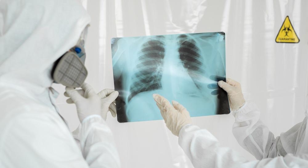 covid-19, x-ray