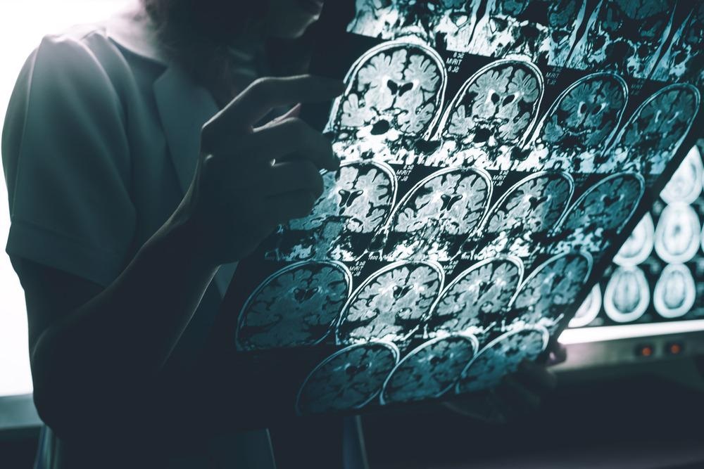 mri brain scan, x-ray brain, alzheimer