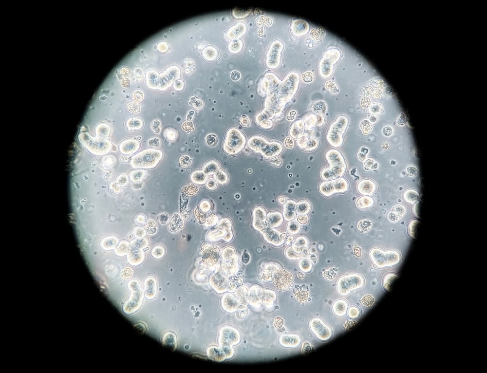 Human breast cancer cells cultured in vitro, phase contrast microscopy