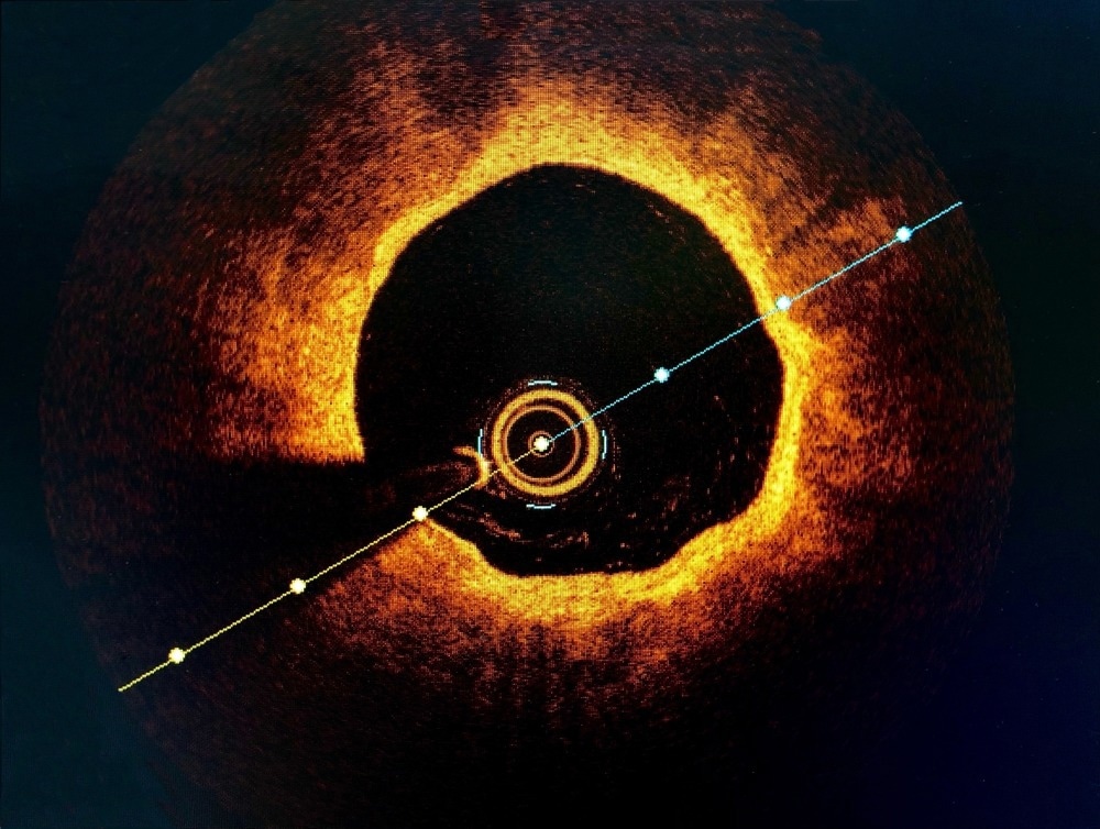 Optical Coherence Tomography