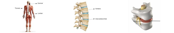 A micro-optic sensor can be used to determine the cause of back problems