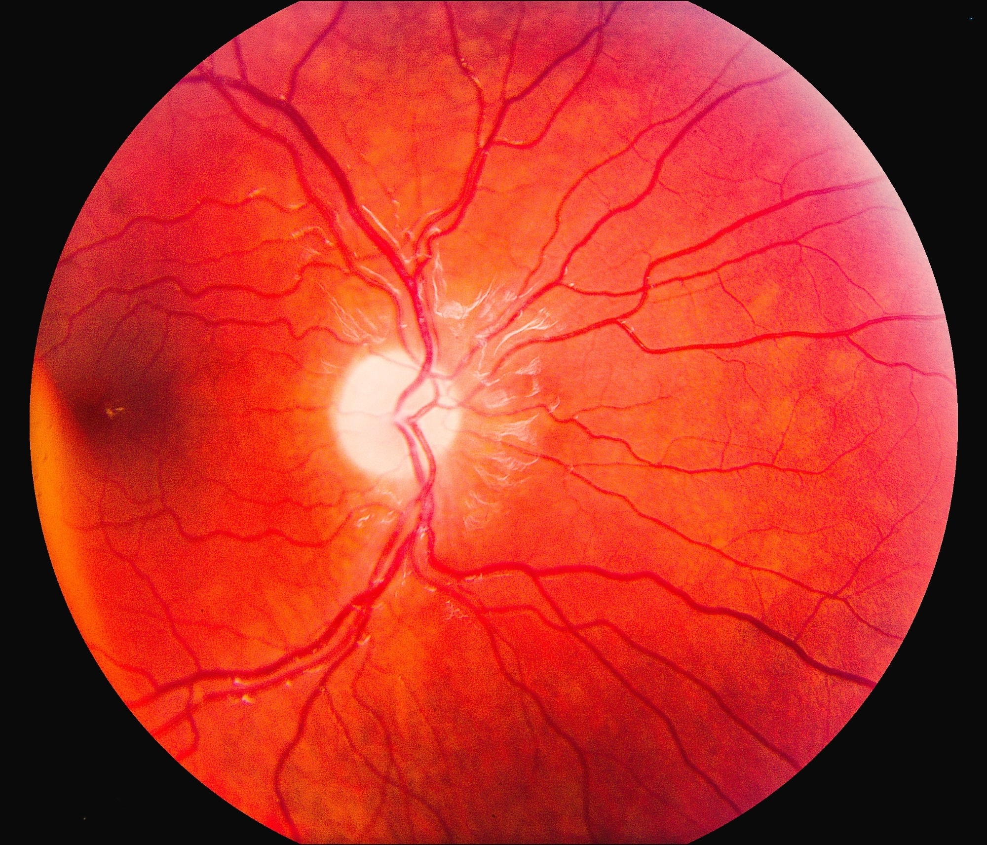 A Human eye retinal screening