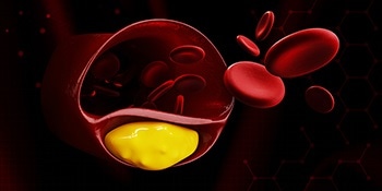 Novel Laser-Based Camera for the Diagnosis and Treatment of Cardiovascular Events