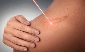 The Types of Lasers Used in Dermatology