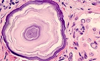 How Can Raman Spectroscopy Improve the Diagnosis of Thyroid Cancer?