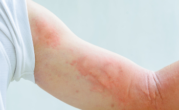 How Can Electron Microscopy Help Our Understanding of Allergic Reactions?