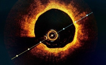 What to Know About Optical Coherence Tomography