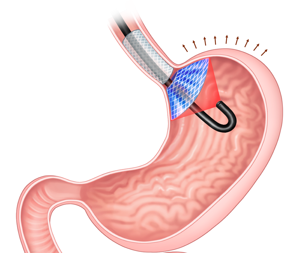 Researchers Develop a Nonsurgical Implant to Treat People with Obesity.