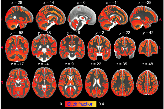 Brain Inflammation Identified in MRI for the Very First Time, a New Study Shows.