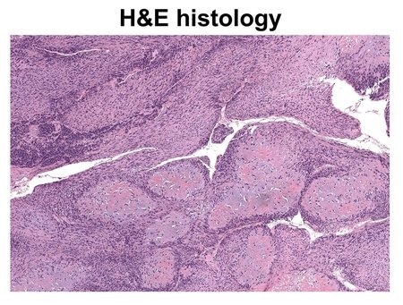 Novel Imaging Technology Identifies Cancerous Bone Tissue