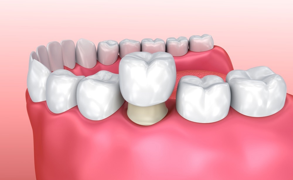 Hyperspectral Imaging System Used For Dental Restoration