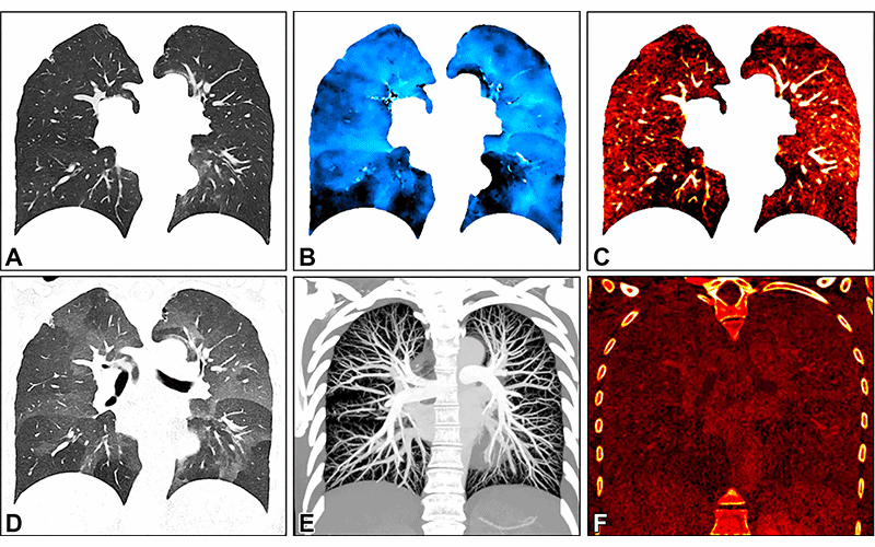 Photon-Counting CT Enhances Assessment of Lung Structure and Function