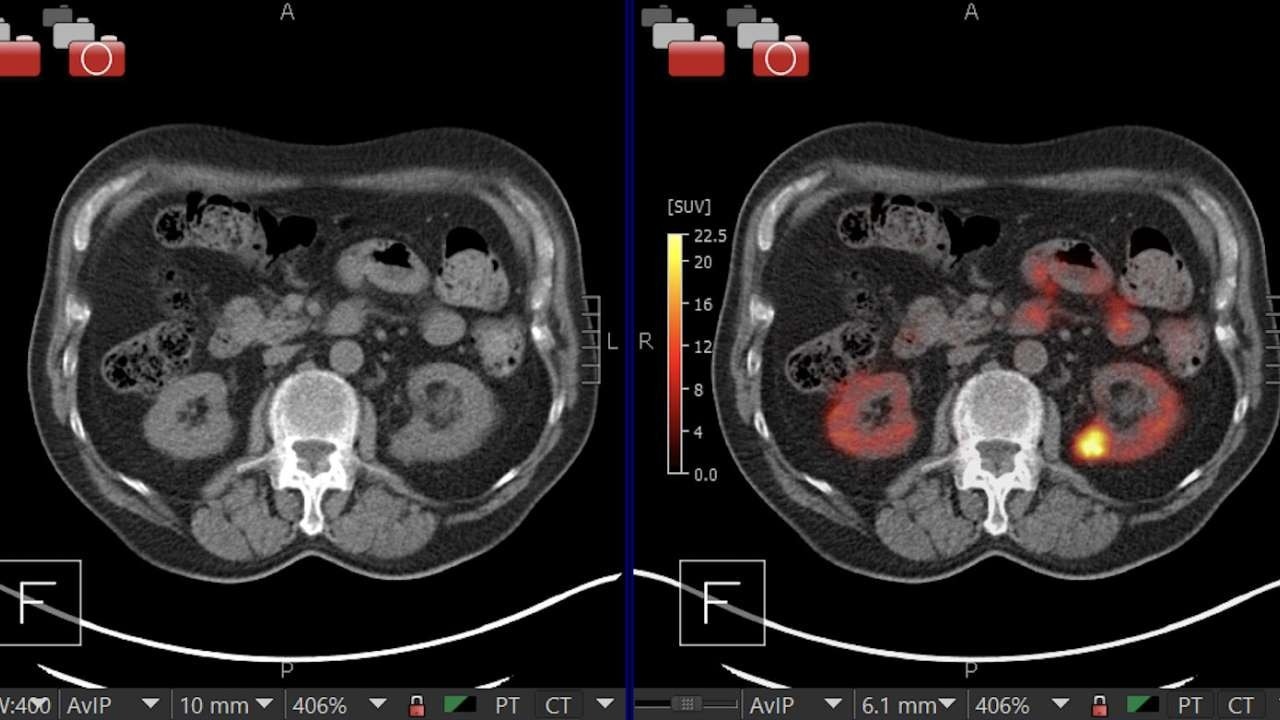 AI-Powered Kidney Cancer Detection