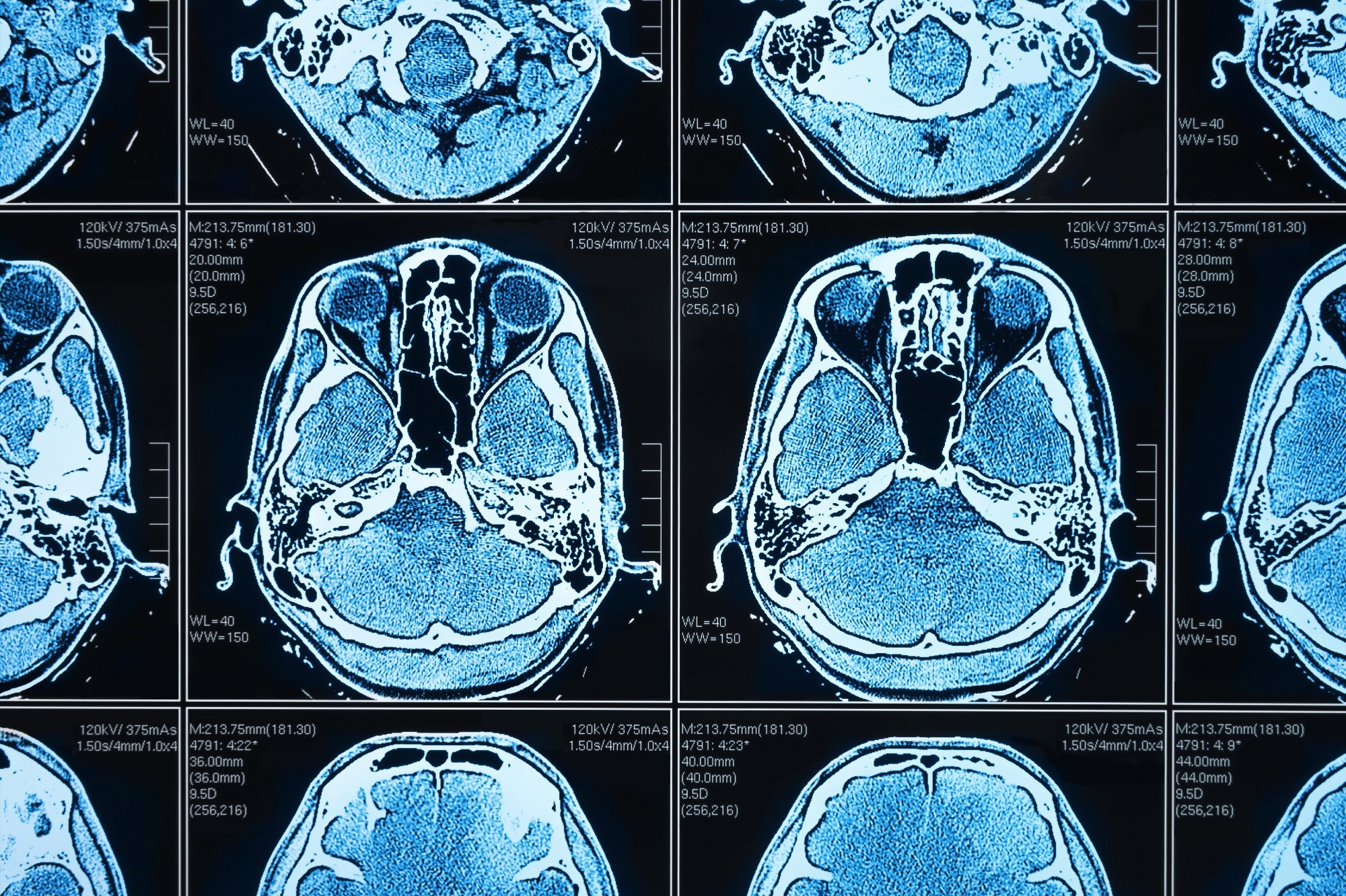 Revolutionizing Biomedical Imaging with Non-Contact Photoacoustic Technology