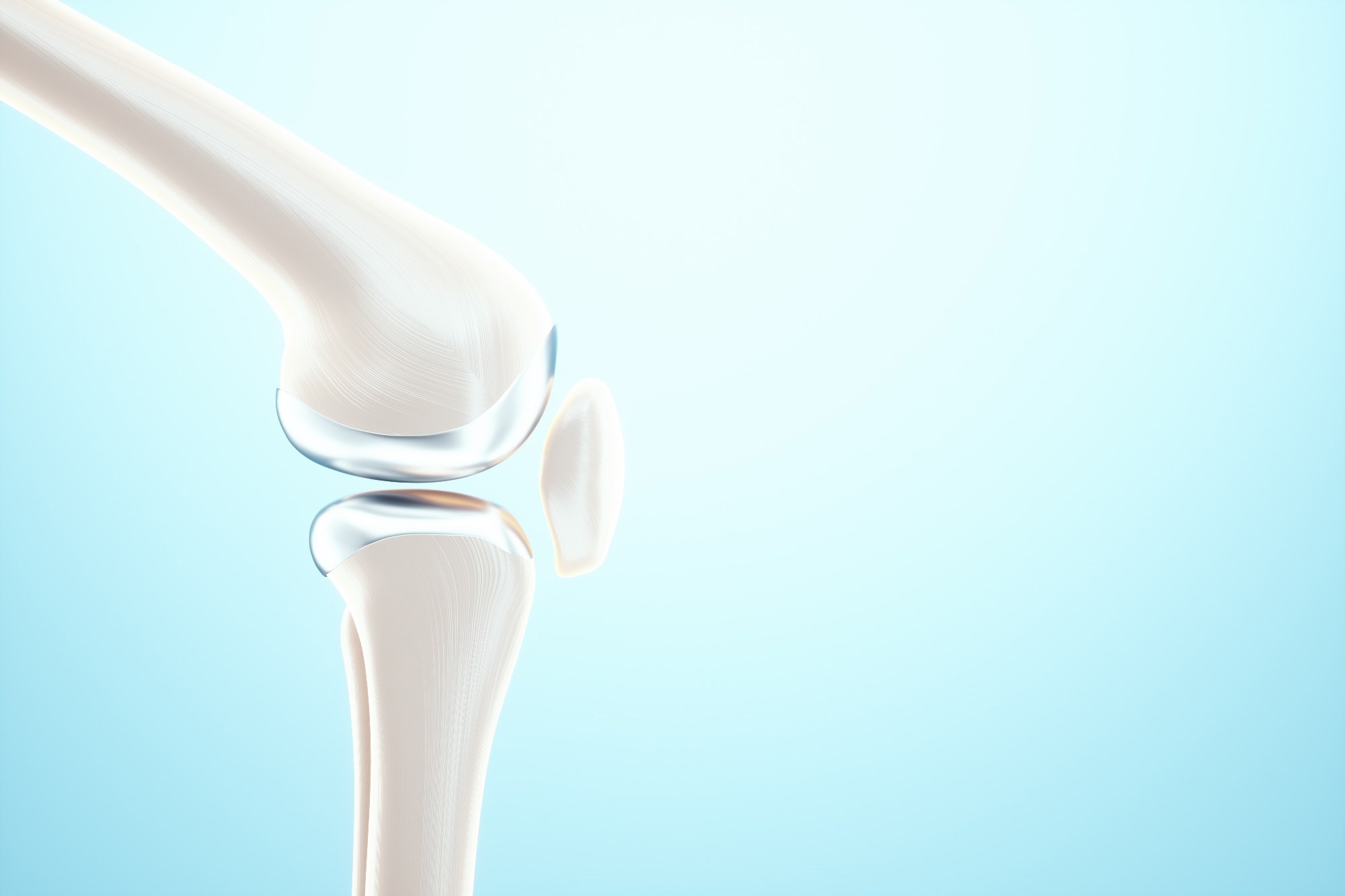 Medical poster image of the bones of the knee, the joint in the knee. Arthritis, inflammation, fracture, cartilage.