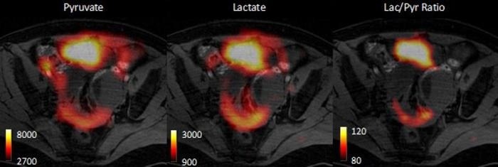 AI-Powered Imaging Predicts Cancer Treatment Response
