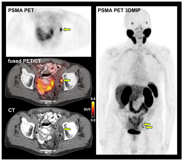 PSMA-PET/CT images of an 85-year-old patient with hormone-sensitive prostate cancer