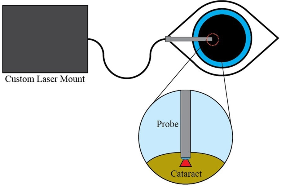Affordable Laser System Revolutionizes Cataract Removal
