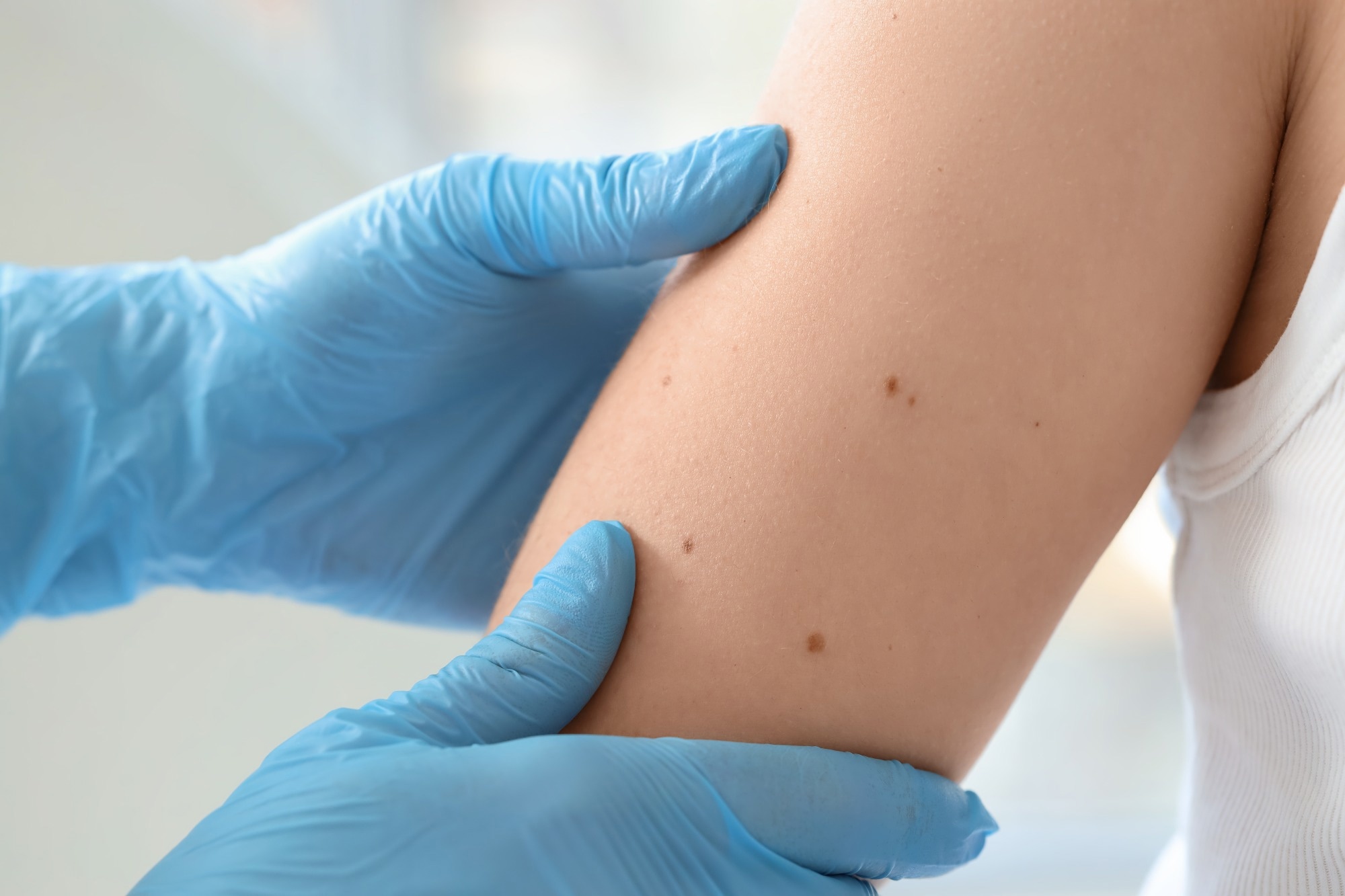 AI-Powered Handheld Scanner Detects Skin Cancer Without Biopsy