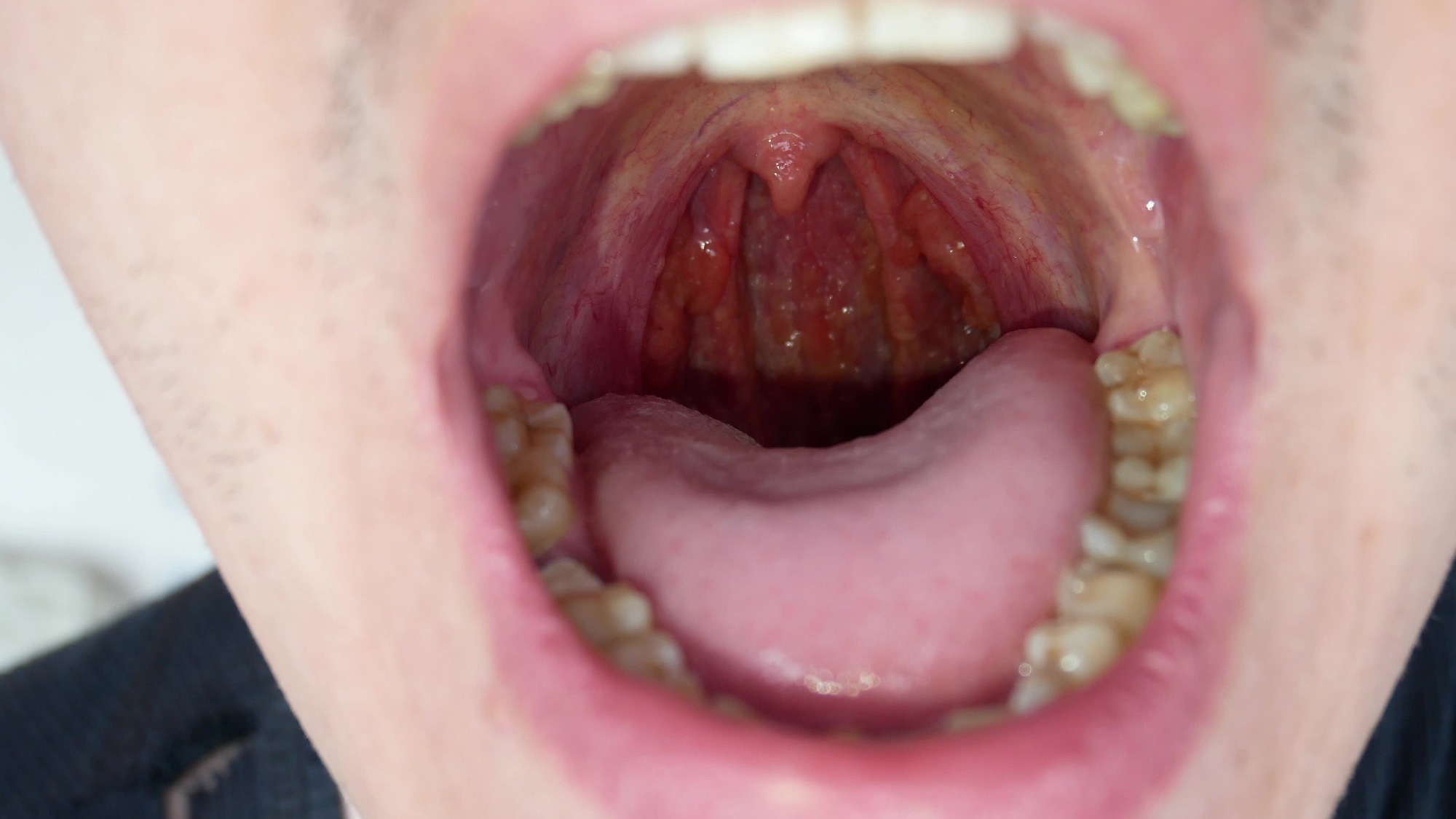 Man with open mouth, showing the throat with tongue and tonsils.