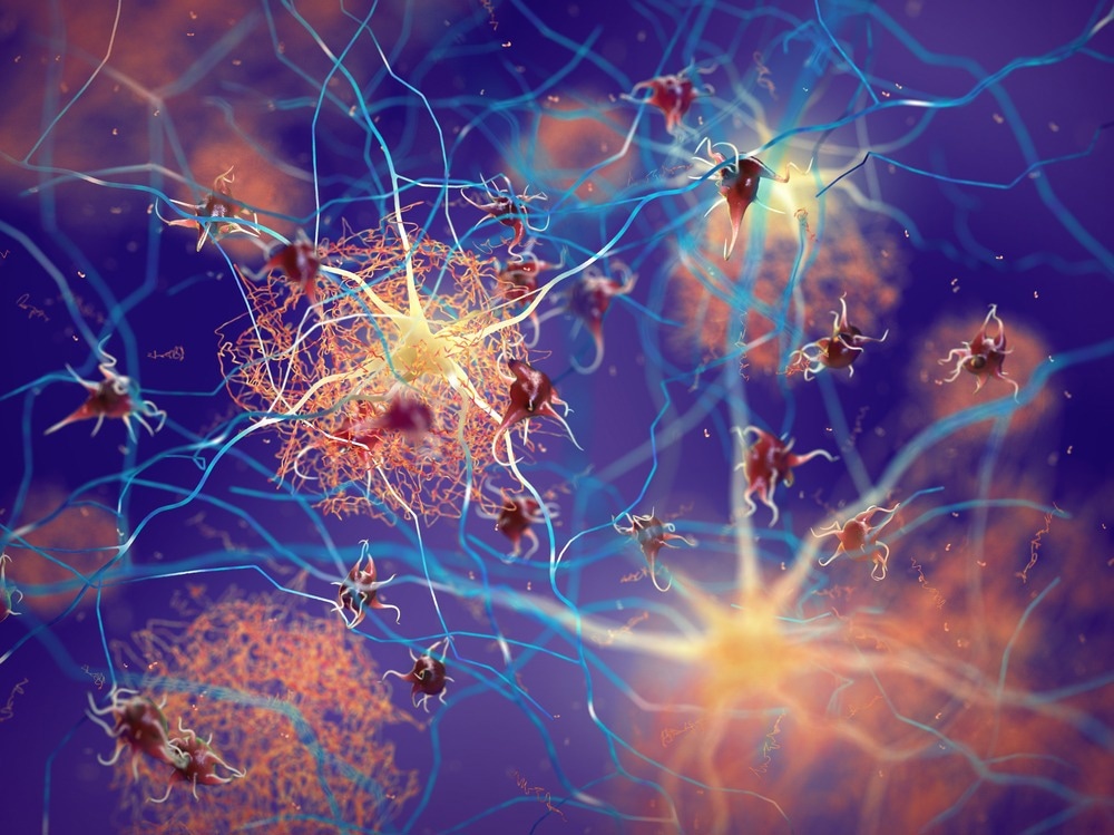 Study Uses Hyperspectral Imaging for Early Alzheimer's Detection