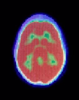 Potential Imaging Agent for Early Diagnosis of Alzheimer’s Disease