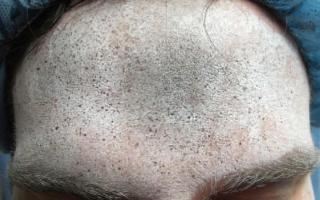 3D Imaging Technique May Help Measure Efficacy of Injectable Wrinkle Reducers