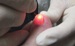 Bay Area Foot and Laser Podiatry Group Completes 1000 PinPointe FootLaser Treatments