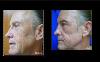 New TotalFX Laser Resurfacing Treatment Reduces Signs of Aging
