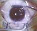 New FLEX Laser Treatment for Short-Sight Problems