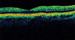 Global Optical Coherence Tomography Market to Grow