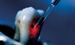 Research Report on Global Dental Laser Market