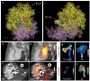Researchers Develop Innovative Imaging Probe that Reveals Dangerous Heart-Valve Disease