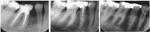 New Study Enables Prediction of Fractures Using Dental X-Rays