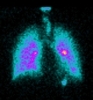Researchers Use 3D Imaging Technique to Shed Light on Chronic Lung Disease