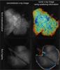 Scattered X-ray Technology May Improve COPD Diagnosis and Therapy
