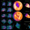 New D-SPECT Nuclear Cardiology Camera Rapidly Detects Heart Disease