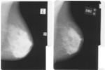 Mammograms Help Assess Effect of Tamoxifen for Breast Cancer Treatment