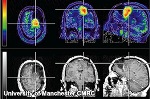 Four Cancer Imaging Centers in UK Get Fund for Tumor Research