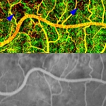 Adaptive Optics Helps Overcome Limitations of Conventional Fluorescein Angiography