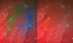 Special Camera System Visualizes Smallest Malignant Pieces of Tumor