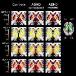 MFC Imaging's Ability to Detect Low Iron Levels May Help Improve ADHD Diagnosis