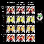 Magnetic Field Correlation Imaging Used in Study of Brain Iron Absorption in ADHD Patients