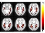 Diffusion Tensor Imaging Helps Attain Volumetric Information of Optic Radiation in Human Brains