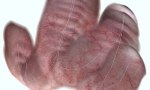 Software Program Provides Panoramic Perspective of Bladder Endoscopy