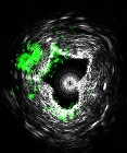 Label-Free Imaging Technology for Diagnosis of Cardiovascular Disease