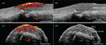 Handheld Device Combines Ultrasound and Photoacoustics